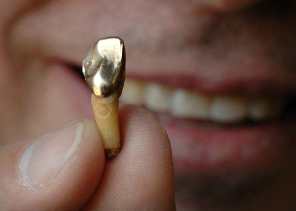 protetyka zębów przy braku dużej liczby zdjęć zębów 